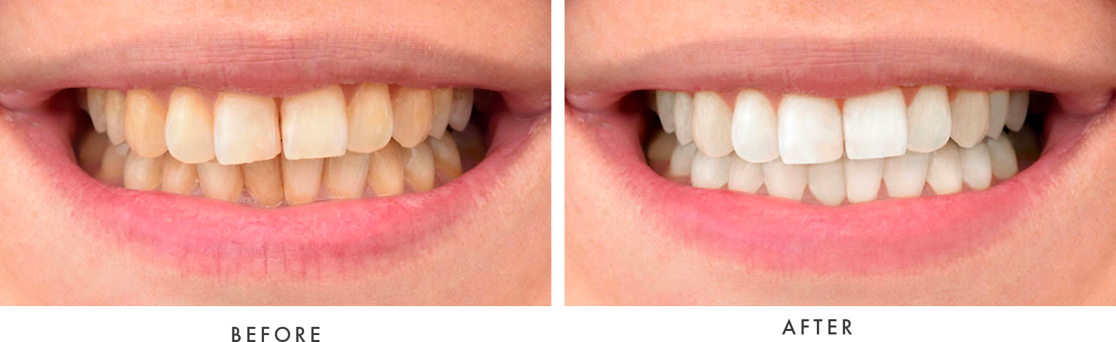 teeth whitening 1