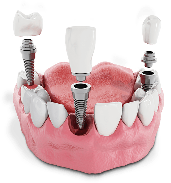 multiple dental implant