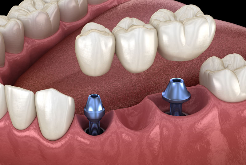 dental implant bridge 3d model