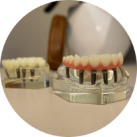 dental implants