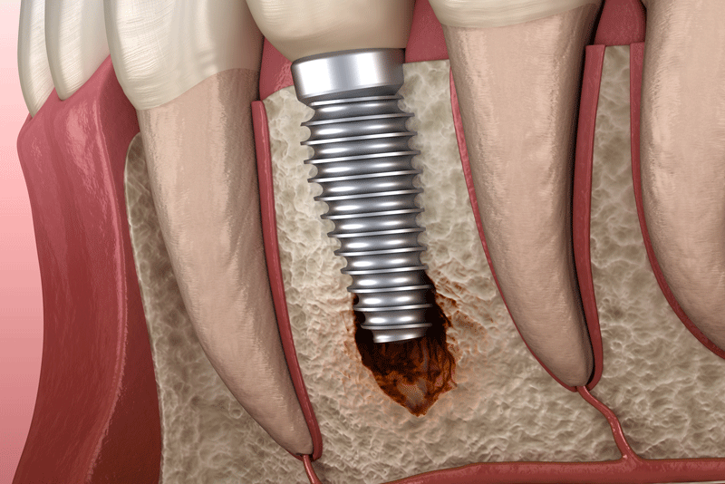 How Can Smoking Lead To Dental Implant Failure?