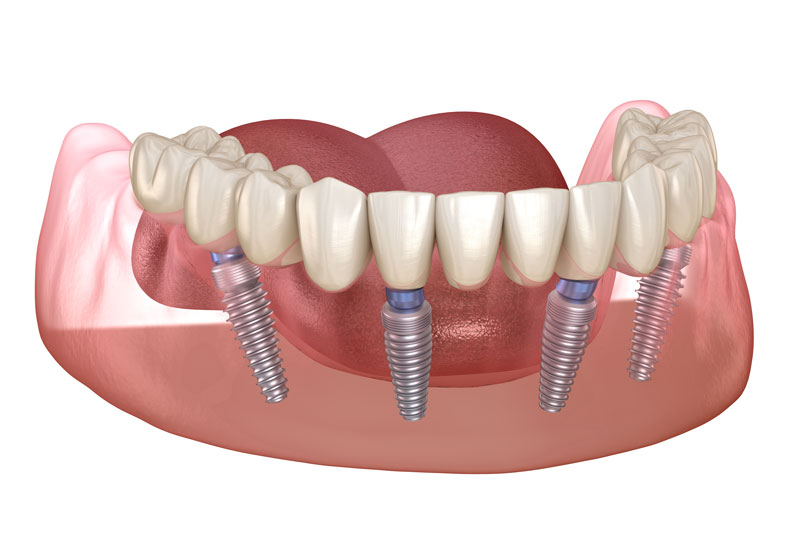 When Do I Need All-On-4 Dental Implants?