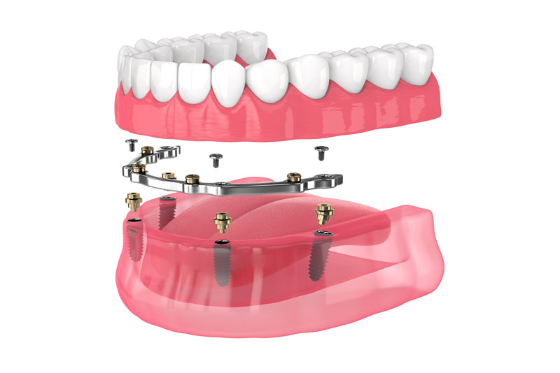 an implant supported denture model.