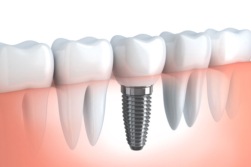 a single dental implant being inserted into a gumline.
