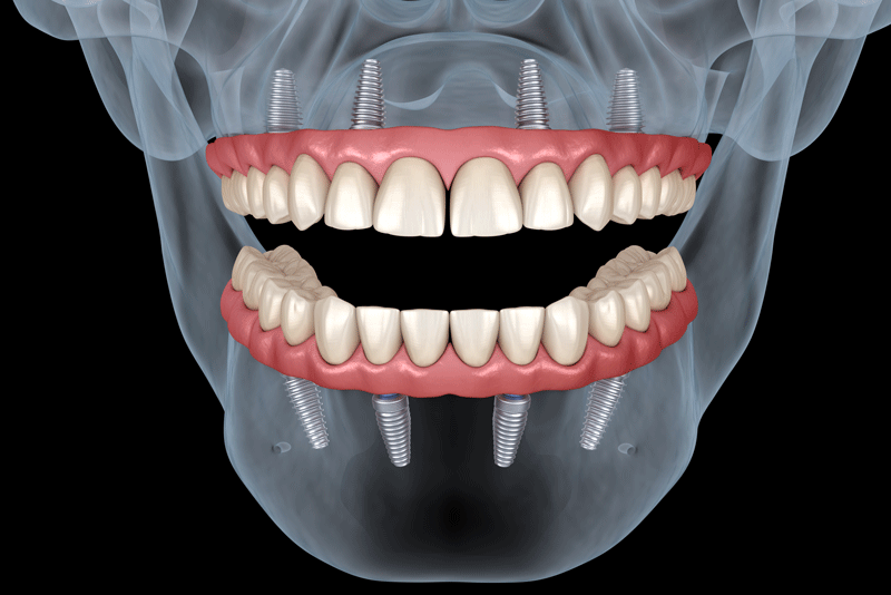 an x-ray image of a patients smile after they have had their unsalvageable teeth extracted and replaced with All-On-4 dental implants in the lower and upper arches.
