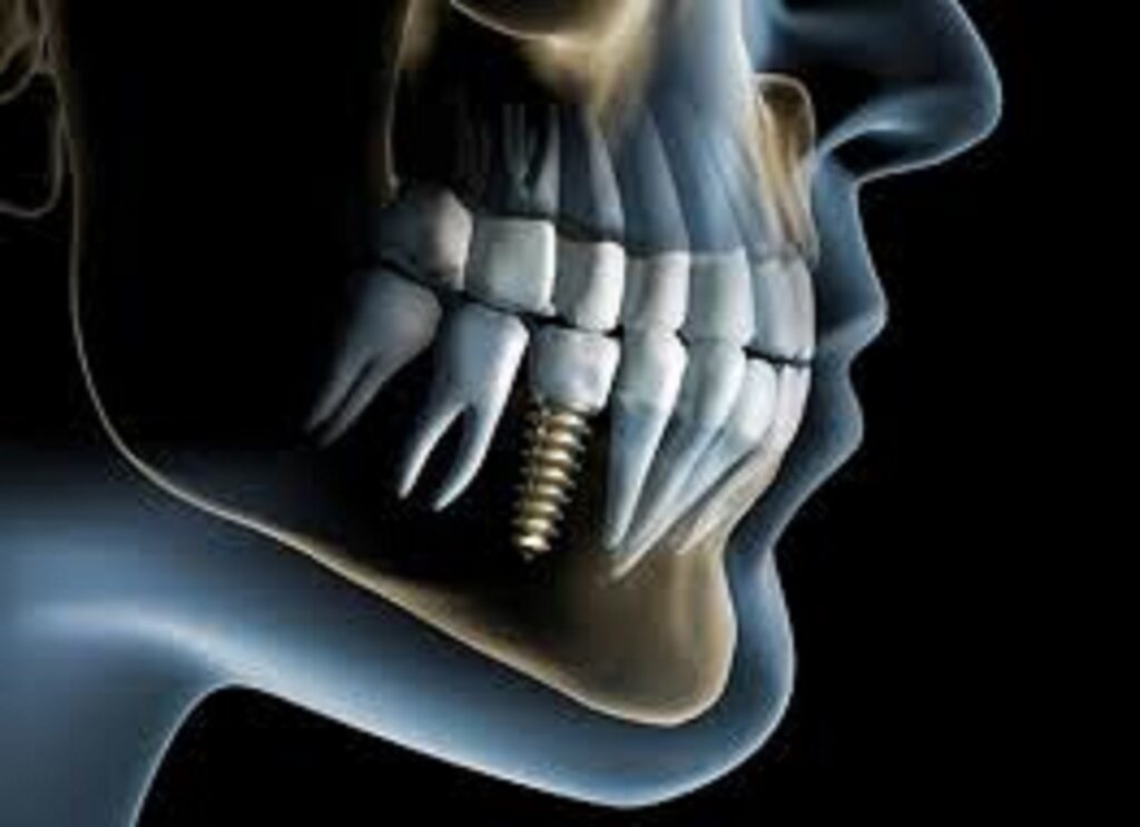 An image of a dental implant on an x-ray.