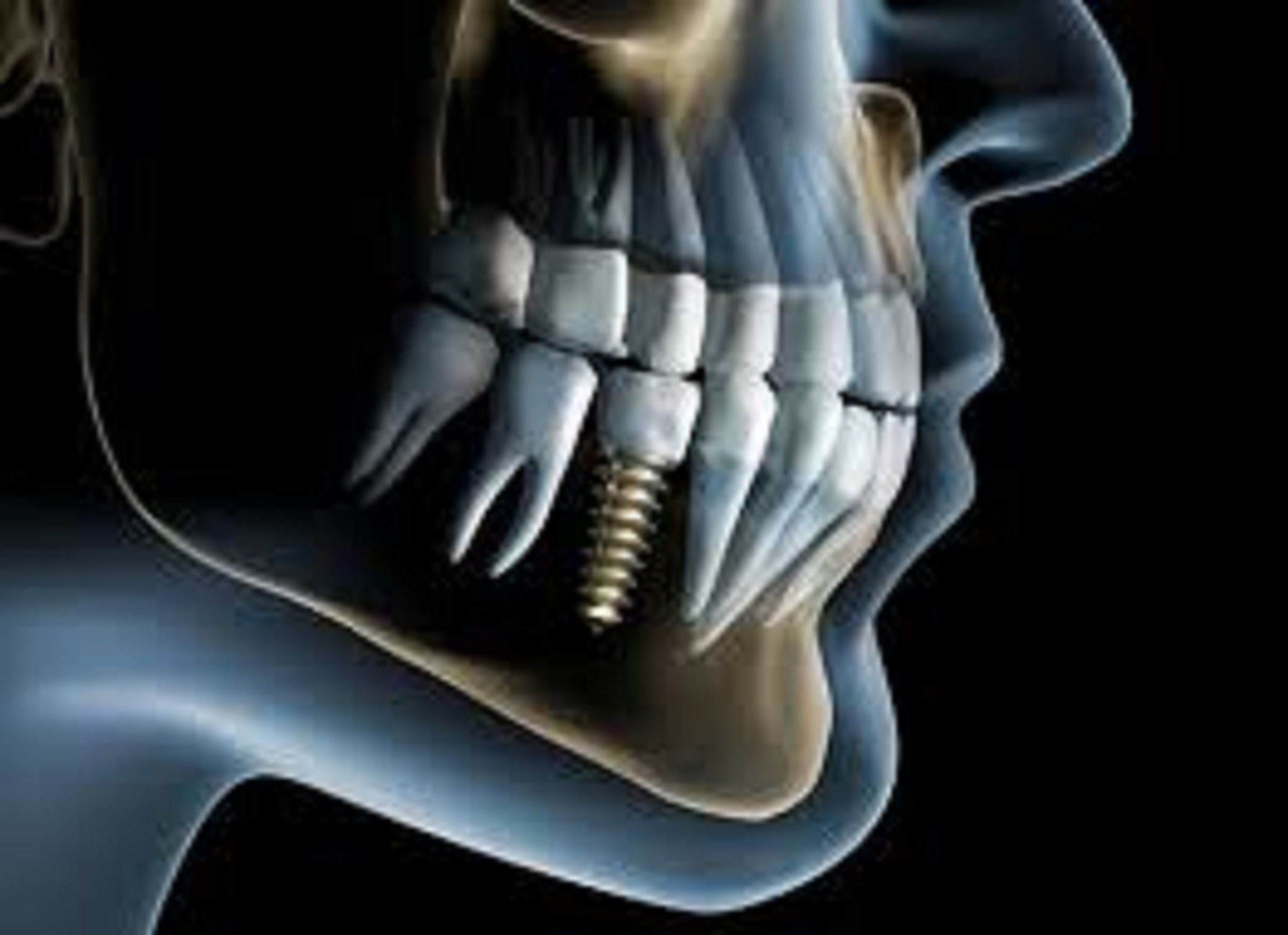 The Parts That Make Up A Dental Implant In Toms River, NJ!