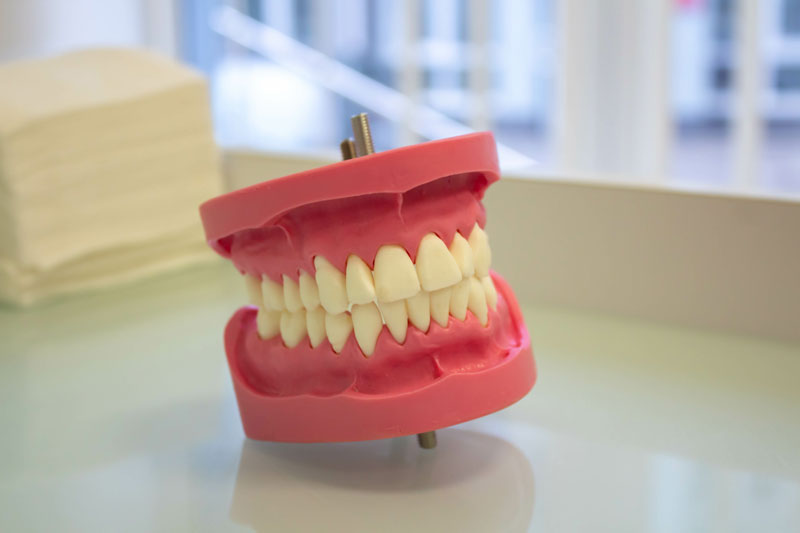 model of full mouth dental implant dentures