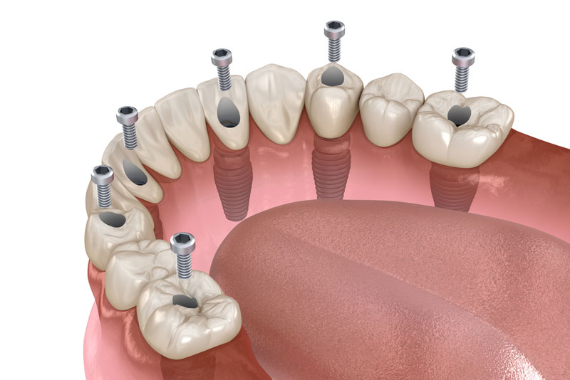 How Many Dental Implants Are Needed In A Full Mouth Dental Implant Procedure?