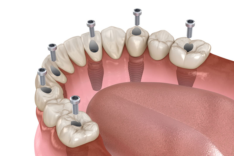 a lower arch full mouth dental implant model that shows how the prosthesis is secured with six dental implants for a dependable full mouth dental implant procedure.