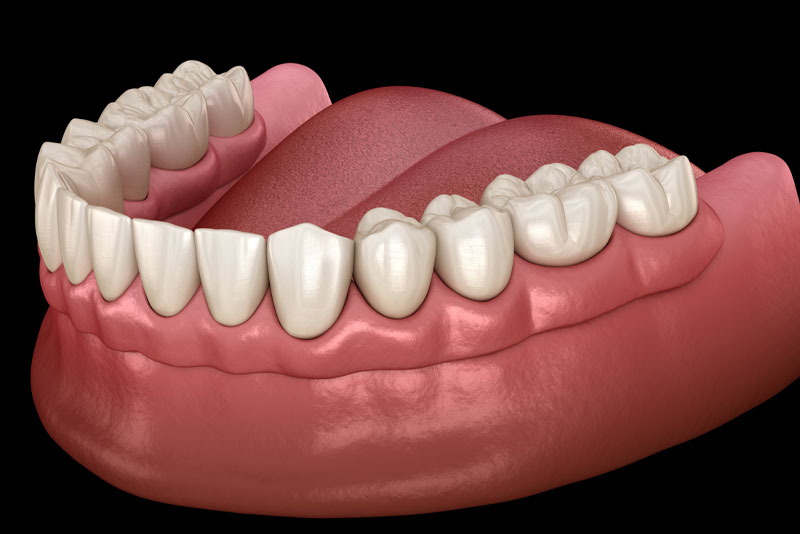 Why Should I Not Get Treated With Traditional Dentures In Toms River, NJ?