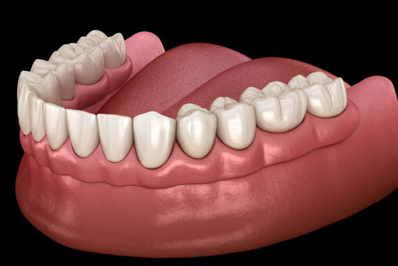 a traditional denture model that shows how, unlike implant supported dentures, traditional dentures do not have dental implants securing it in place.