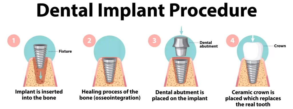 dental implants in nj