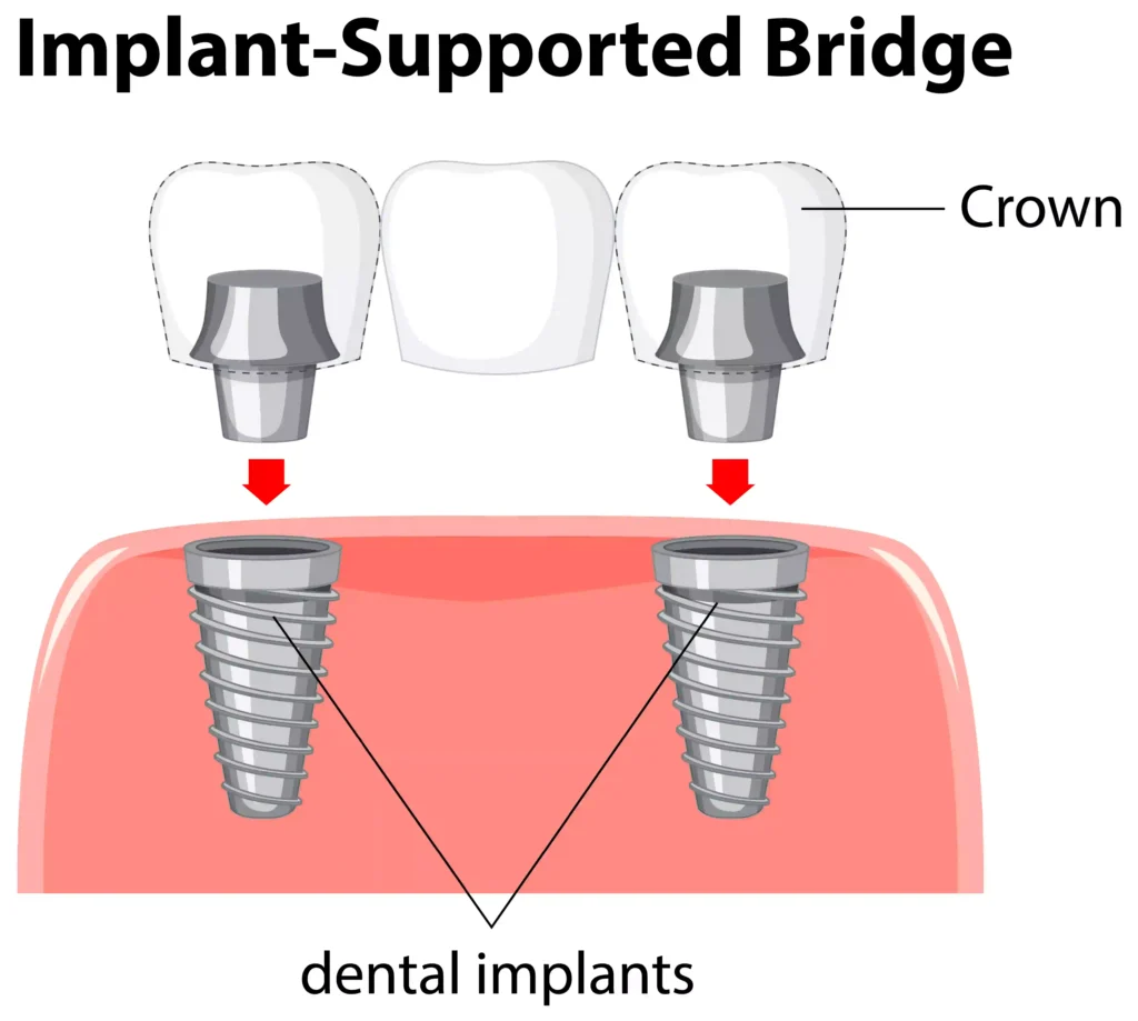 Tooth Bridge vs Implant