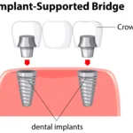 Tooth Bridge vs Implant
