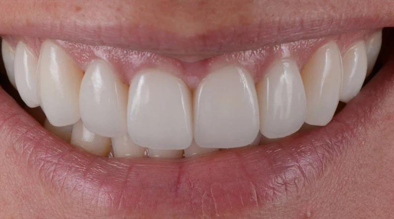 How Much do Veneers Cost