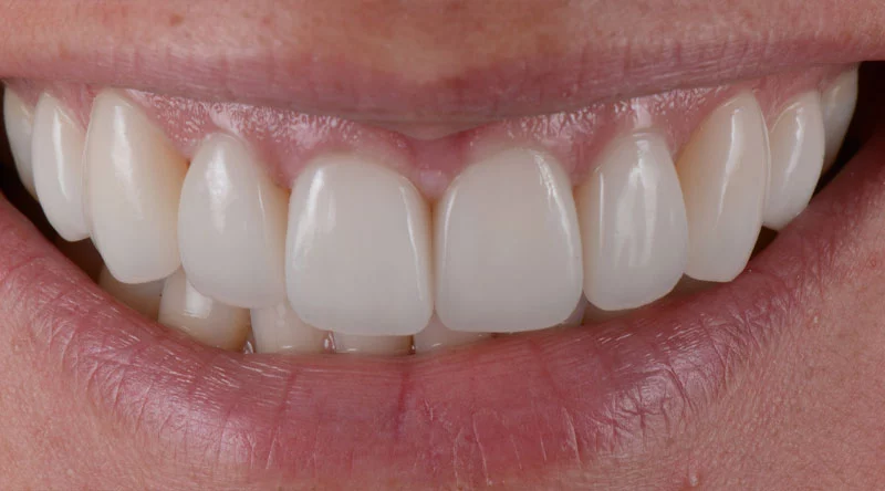 Porcelain Veneers After image