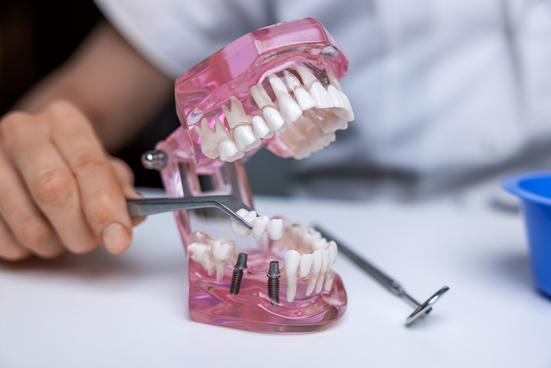 dentist implantologist showing dental bridge implant technology on human tooth jaw model